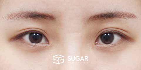 슈가성형외과 첫) 절개 + 눈매교정 + 윗트임 + 뒤밑트임 전후사진 - 수술 전