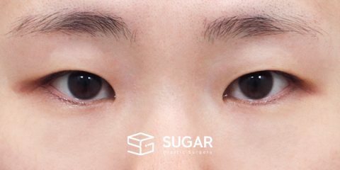 슈가성형외과 첫) 자연유착 + 눈매교정 + 앞트임 + 윗트임 전후사진 - 수술 전