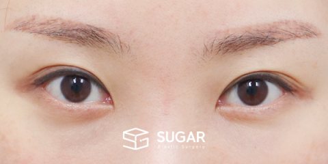 슈가성형외과 첫) 자연유착 + 눈매교정 + 윗트임 + 뒤밑트임 전후사진 - 수술 전