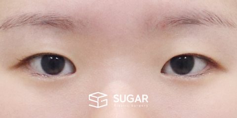 슈가성형외과 첫) 자연유착 + 앞트임 + 윗트임 + 뒤밑트임 전후사진 - 수술 전