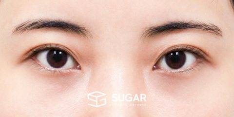 슈가성형외과 첫) 뒤밑트임 전후사진 - 수술 전