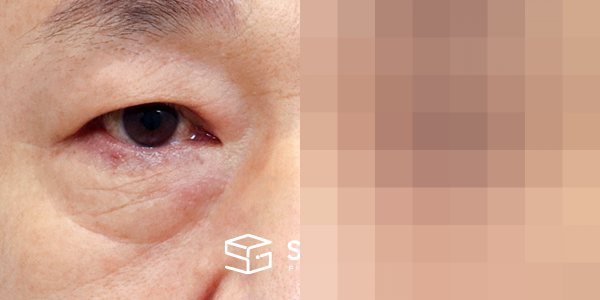 슈가성형외과 첫) 눈썹 거상 + 중안면부 거상 + 하안검 + 자연유착 전후사진 - 정면 수술 전후 비교