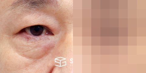 슈가성형외과 첫) 눈썹 거상 + 중안면부 거상 + 하안검 + 자연유착 전후사진 - 정면 수술 전후 비교