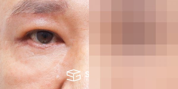 슈가성형외과 첫) 눈썹 거상 + 중안면부 거상 + 하안검 + 자연유착 전후사진 - 45도 수술 전후 비교