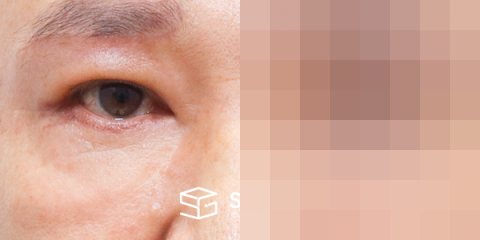 슈가성형외과 첫) 눈썹 거상 + 중안면부 거상 + 하안검 + 자연유착 전후사진 - 45도 수술 전후 비교