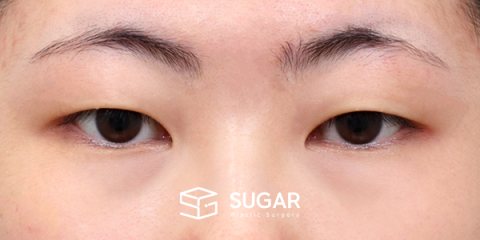 슈가성형외과 첫) 절개 + 눈 밑 지방재배치 + 윗트임 + 뒤밑트임 전후사진 - 수술 전