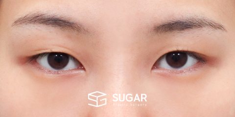 슈가성형외과 첫) 자연유착 + 눈매교정 + 윗트임 전후사진 - 수술 전