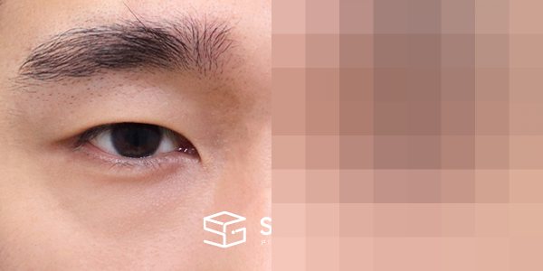 슈가성형외과 첫) 자연유착 + 눈매교정 전후사진 - 정면 수술 전후 비교