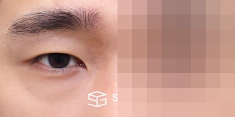 슈가성형외과 첫) 자연유착 + 눈매교정 전후사진 - 정면 수술 전후 비교