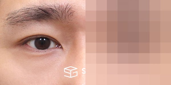 슈가성형외과 첫) 자연유착 + 눈매교정 전후사진 - 45도 수술 전후 비교