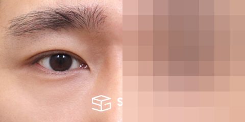 슈가성형외과 첫) 자연유착 + 눈매교정 전후사진 - 45도 수술 전후 비교