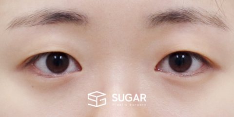 슈가성형외과 첫) 절개 + 윗트임 전후사진 - 수술 전