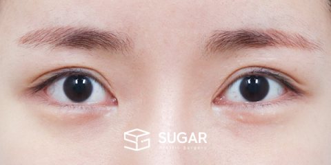 슈가성형외과 재) 재수술 + 절개(두 줄 따기) + 뒤밑트임 전후사진 - 수술 전