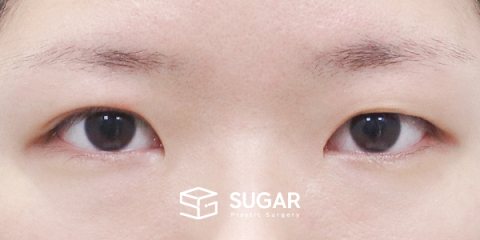 슈가성형외과 재) 재수술 + 자연유착 + 눈매교정 + 앞트임 + 윗트임 + 눈 두덩이 지방 제거 전후사진 - 수술 전