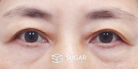 슈가성형외과 첫) 중안면부 거상 + 하안검 전후사진 - 수술 전