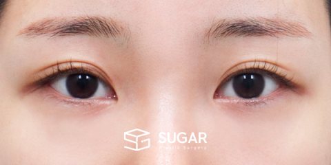 슈가성형외과 첫) 뒤밑트임 전후사진 - 수술 전