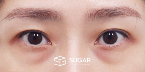 슈가성형외과 첫) 눈 밑 지방재배치 + 뒤밑트임 전후사진 - 수술 전