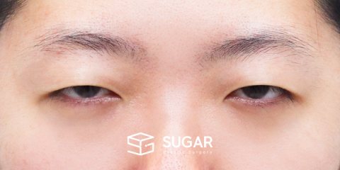 슈가성형외과 첫) 자연유착 + 눈매교정 + 윗트임 전후사진 - 수술 전