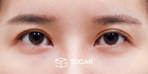 슈가성형외과 재) 재수술 + 절개(두 줄 따기) + 눈매교정 + 뒤밑트임 전후사진 - 수술 전