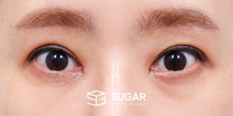 슈가성형외과 첫) 중안면부 거상 + 하안검 + 뒤밑트임 전후사진 - 수술 전