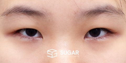 슈가성형외과 첫) 절개 + 앞트임 + 윗트임 전후사진 - 수술 전