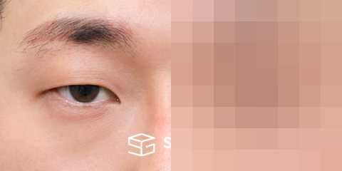 슈가성형외과 첫) 자연유착 + 눈매교정 전후사진 - 정면 수술 전후 비교