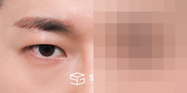 슈가성형외과 첫) 자연유착 + 눈매교정 전후사진 - 45도 수술 전후 비교