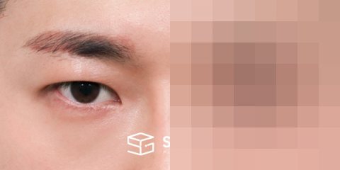 슈가성형외과 첫) 자연유착 + 눈매교정 전후사진 - 45도 수술 전후 비교