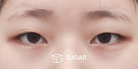 슈가성형외과 첫) 자연유착 + 눈매교정 전후사진 - 수술 전