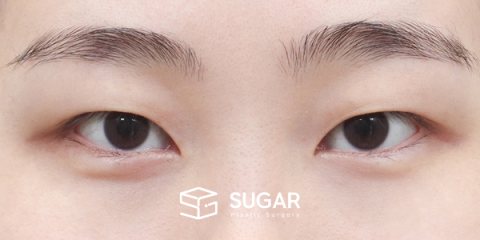 슈가성형외과 첫) 자연유착 + 눈 위 지방제거 전후사진 - 수술 전