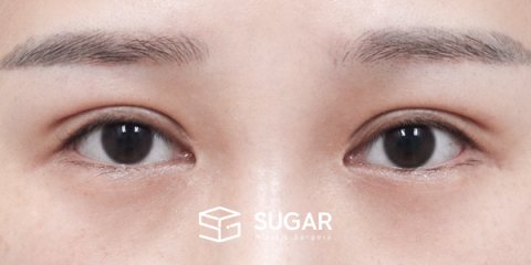 슈가성형외과 재) 재수술(두 줄 따기) + 절개 + 뒤밑트임 전후사진 - 수술 전