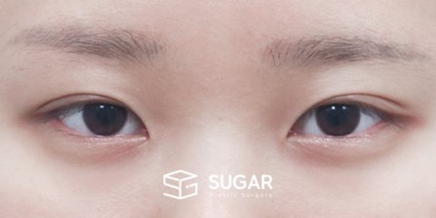 슈가성형외과 첫) 절개 + 앞트임 + 윗트임 + 뒤밑트임 전후사진 - 수술 전