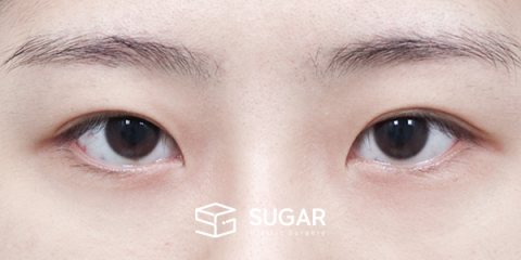 슈가성형외과 첫) 절개 + 윗트임 + 뒤밑트임 전후사진 - 수술 전