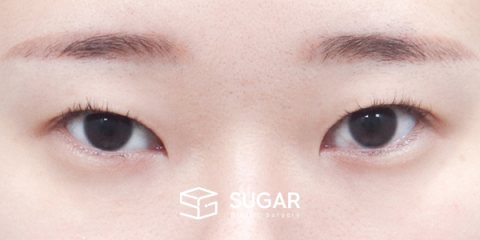 슈가성형외과 첫) 자연유착 + 눈매교정 + 윗트임 + 뒤밑트임 전후사진 - 수술 전