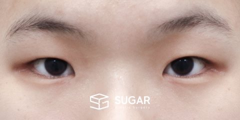 슈가성형외과 첫) 절개 + 앞트임 + 뒤밑트임 전후사진 - 수술 전