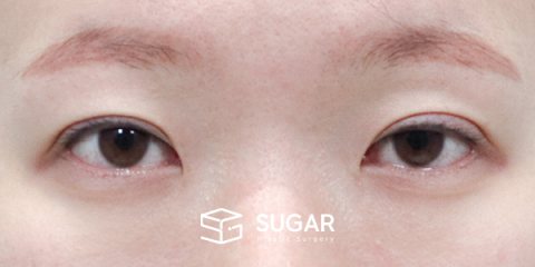 슈가성형외과 재) 재수술 + 절개 + 눈매교정 + 윗트임 전후사진 - 수술 전