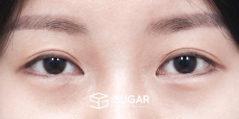 슈가성형외과 재) 재수술 + 뒤밑트임 전후사진 - 수술 전