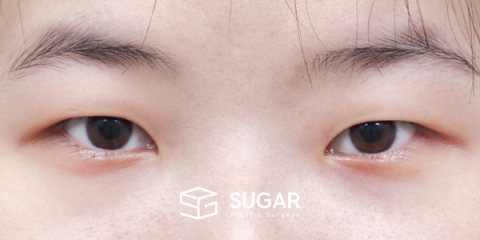 슈가성형외과 첫) 절개 + 눈매교정 + 앞트임 + 뒤밑트임 전후사진 - 수술 전