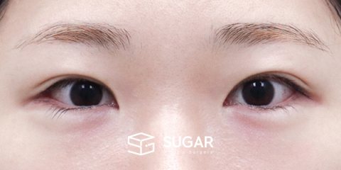 슈가성형외과 재) 재수술 + 자연유착 + 눈매교정 + 윗트임 + 2Point 밑트임 전후사진 - 수술 전