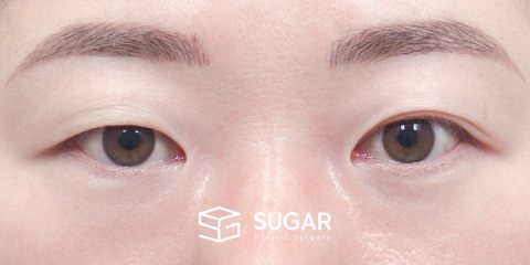 슈가성형외과 첫) 절개 + 윗트임 전후사진 - 수술 전