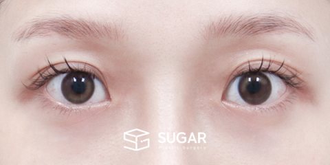 슈가성형외과 첫) 앞트임 + 윗트임 + 뒤밑트임 전후사진 - 수술 전