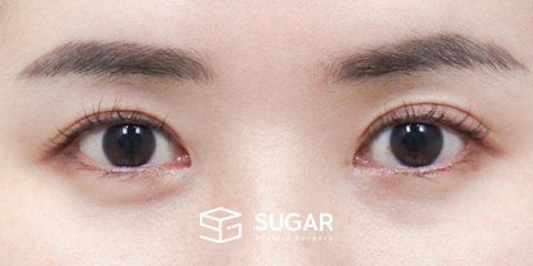 슈가성형외과 첫) 절개 + 뒤밑트임 전후사진 - 수술 전