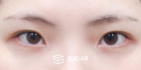 슈가성형외과 첫) 앞트임 + 윗트임 전후사진 - 수술 전
