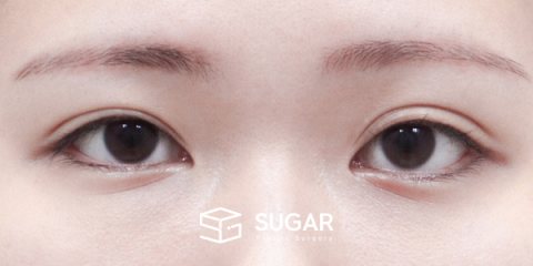 슈가성형외과 첫) 자연유착 + 눈매교정 전후사진 - 수술 전
