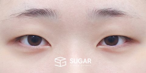 슈가성형외과 첫) 절개 + 윗트임 전후사진 - 수술 전