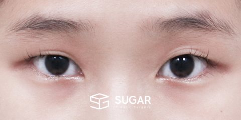 슈가성형외과 첫) 자연유착 + 눈매교정 전후사진 - 수술 전