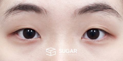 슈가성형외과 첫) 자연유착 + 앞트임 + 뒤밑트임 전후사진 - 수술 전