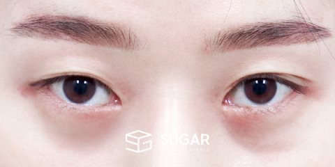 슈가성형외과 재) 재수술 + 자연유착 + 눈매교정 + 뒤밑트임 + 눈 밑 지방이식 전후사진 - 수술 전