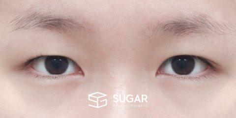 슈가성형외과 첫) 절개 + 뒤밑트임 전후사진 - 수술 전