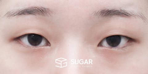 슈가성형외과 첫) 자연유착 + 눈매교정 전후사진 - 수술 전